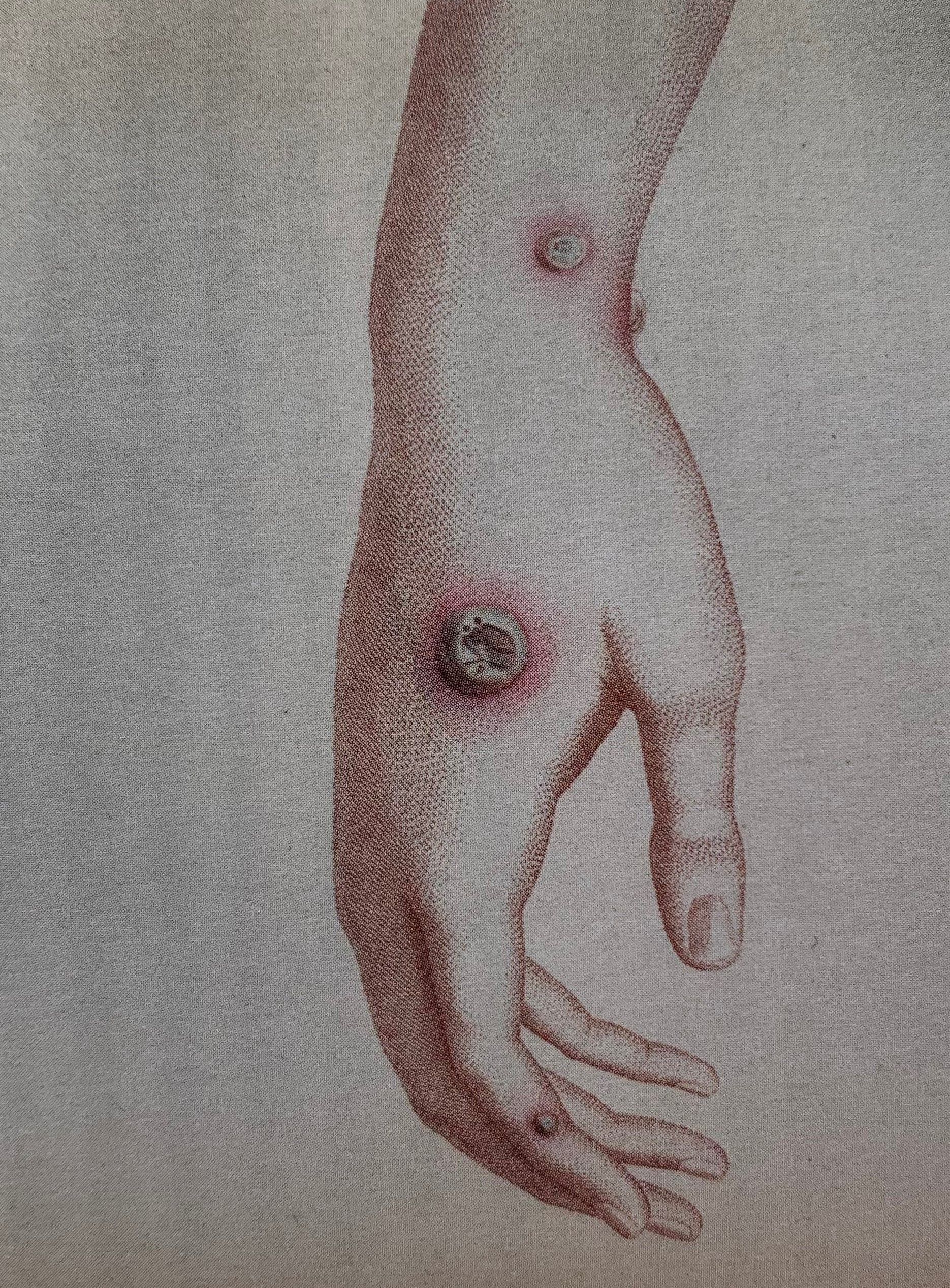 Tecknad bild på en hand med utslag av kokoppor