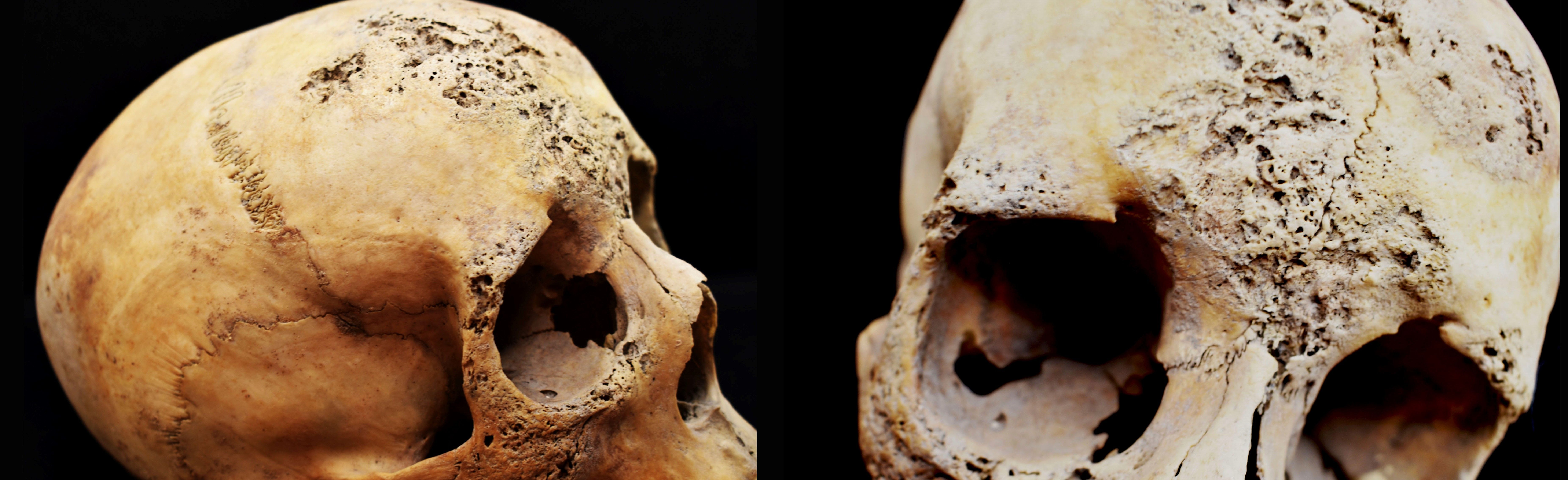Två kranier som visar tydliga patologiska  förändringar runt ögon och panna samt suturen i pannan