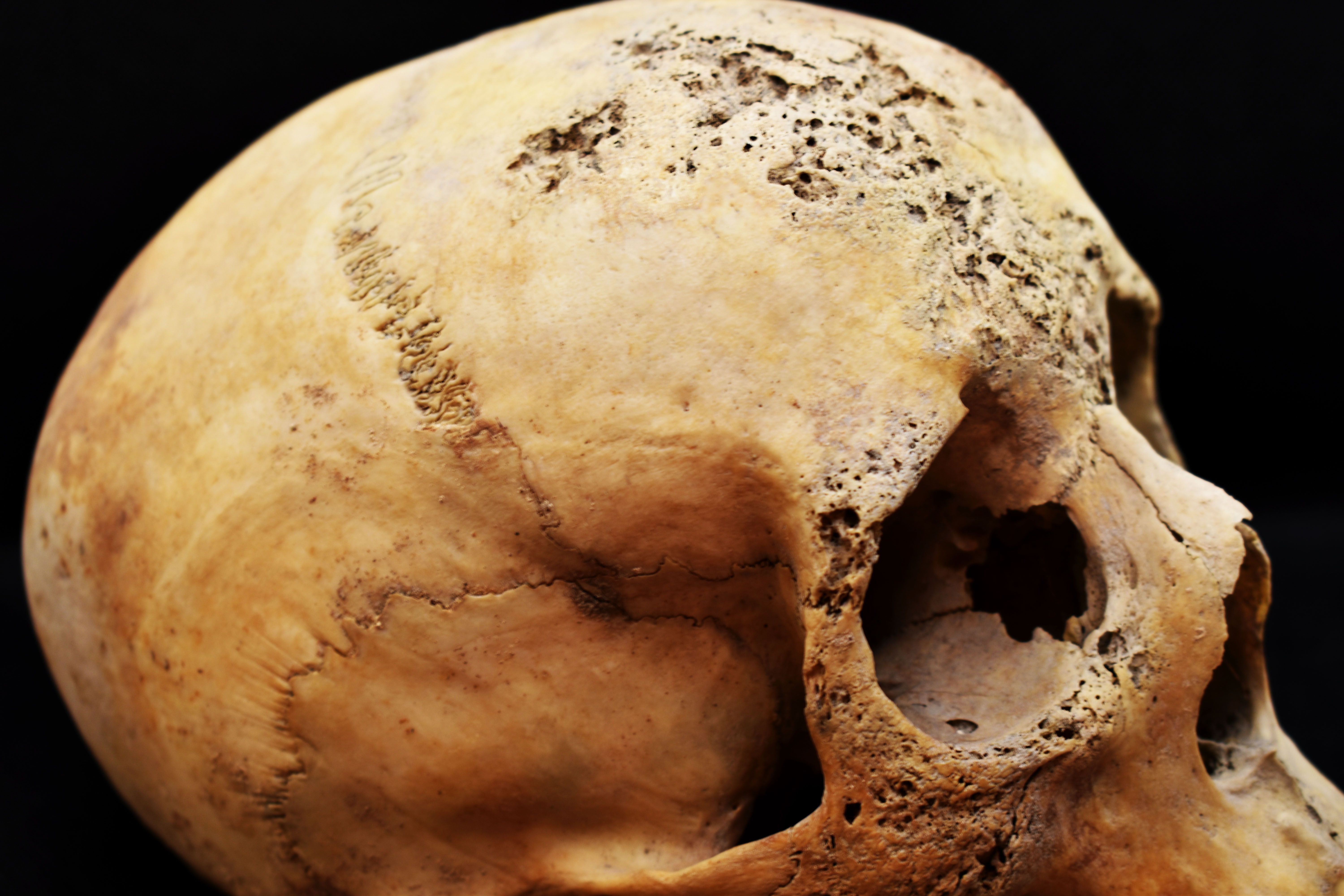 Kraniet i närbild med tydliga patologiska förändringar.